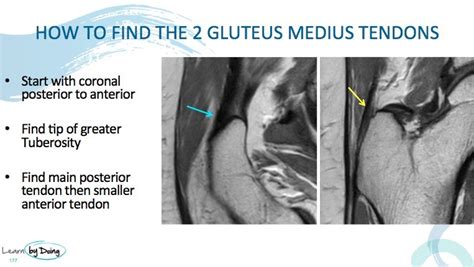 test for glut med tear|gluteus medius tears mri.